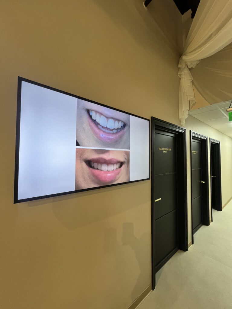 Digital signage display showcasing before and after results of lip filler